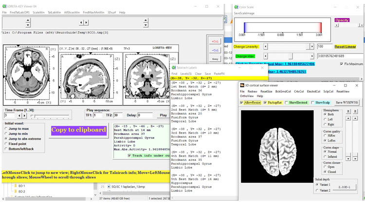 Figure 4 - Baseline eyes-closed z-score LORETA analysis for 3 Hz